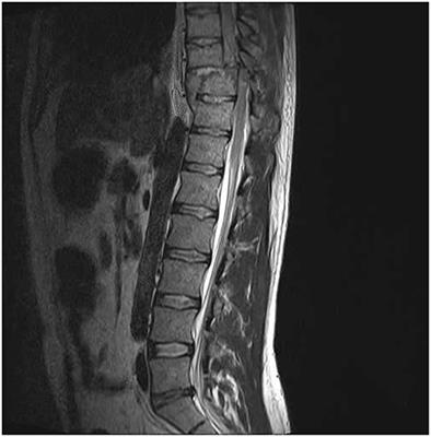 A Human Sensory Pathway Connecting the Foot to Ipsilateral Face That Partially Bypasses the Spinal Cord